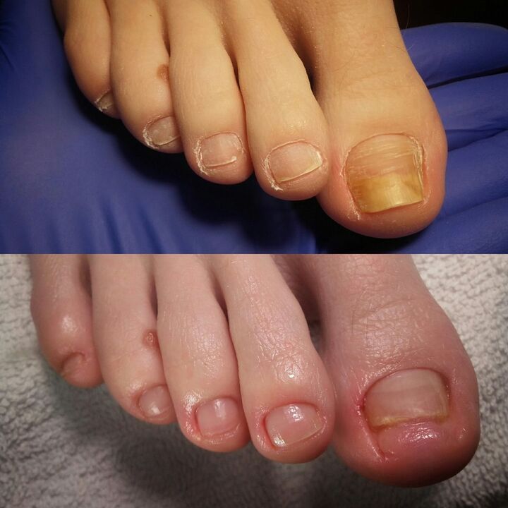 Prije i nakon nanošenja Krema Fark Exodermin Brand iz Yesenia