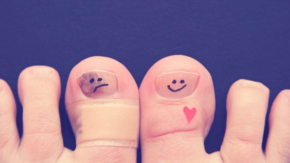 nokat s gljivicama i zdrav