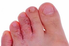 gljivice na nožnim prstima